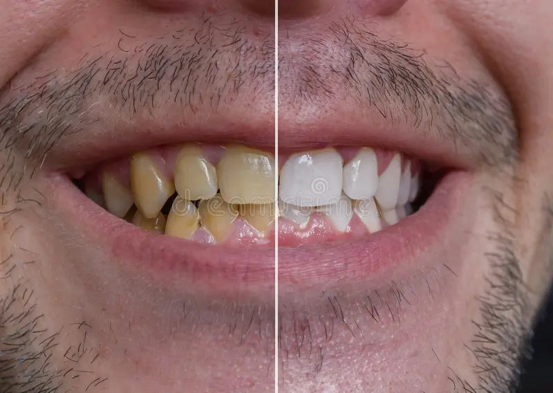 Kit de Blanchiment Dentaire GlorySmile Résultats Professionnels à Domicile